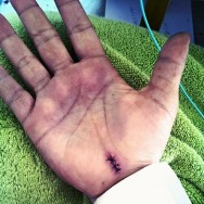 My hand after Carpal Tunnel Release surgery
